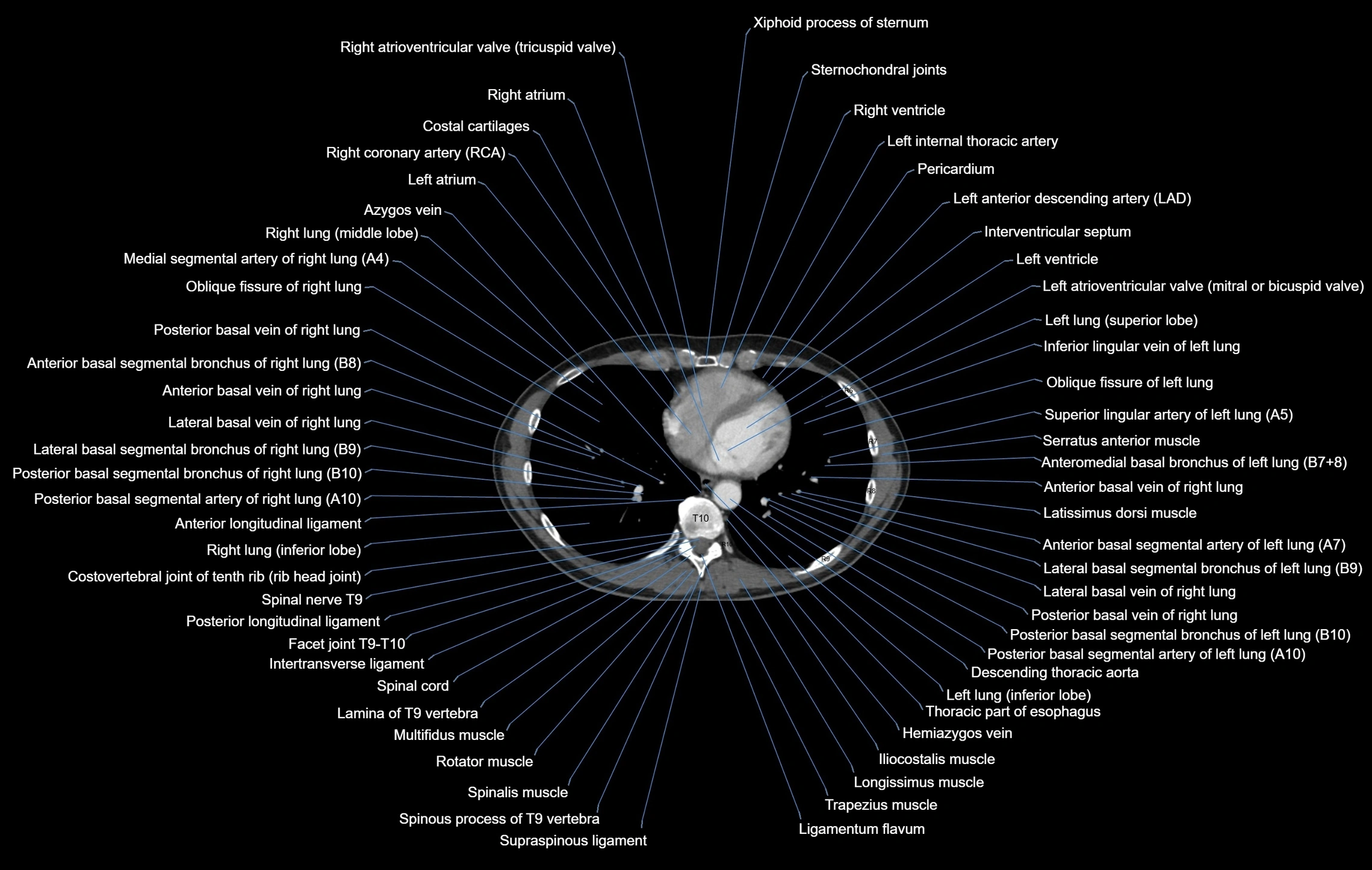 CT chest (thorax) labelled axial cross sectional anatomy radiology image-00082.webp